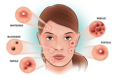 process of Acne