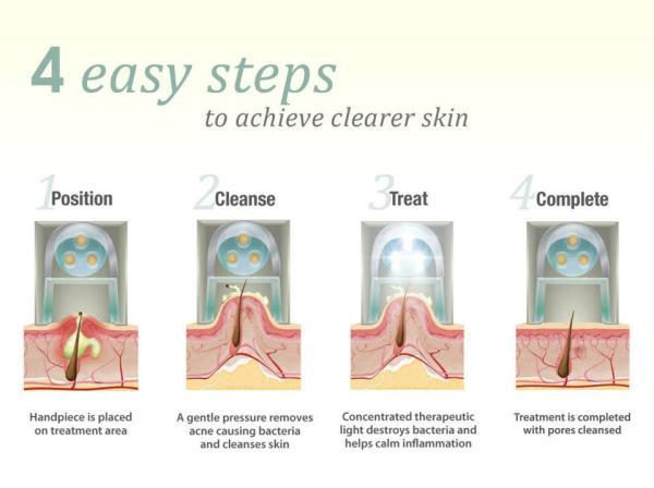 steps to fix Acne